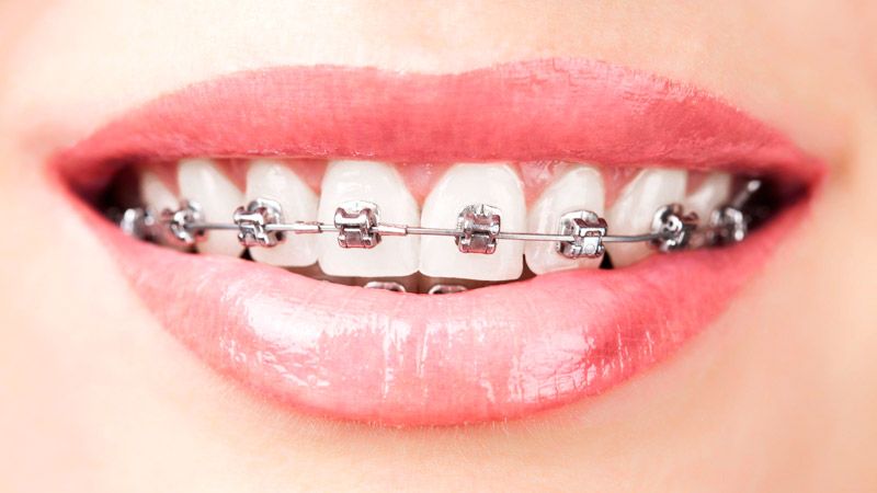 Sonrisa con ortodoncia